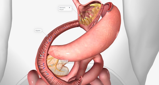 B12 and Intrinsic Factor in the Stomach with Gastric Bypass