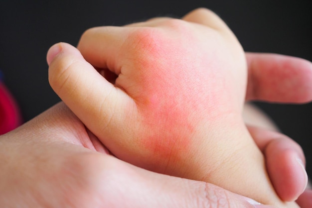 Baby hand with skin rash and allergy with red spot cause by mosquito bite