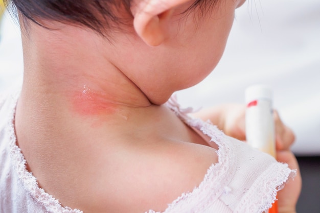 Baby skin rash and allergy with red spot cause by mosquito bite at neck