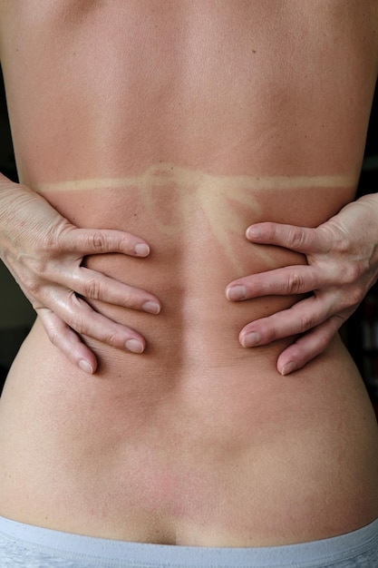 Back of caucasian woman with red skin and bikini print after
sunbathing on the beach