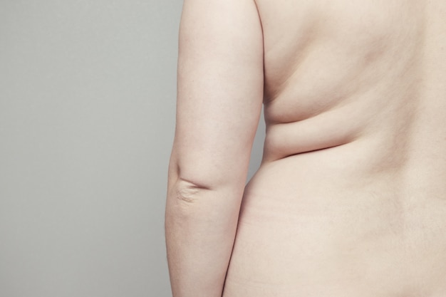 Parte posteriore del corpo spesso nudo femminile con pieghe sulla pelle. obesità e malattie terminali