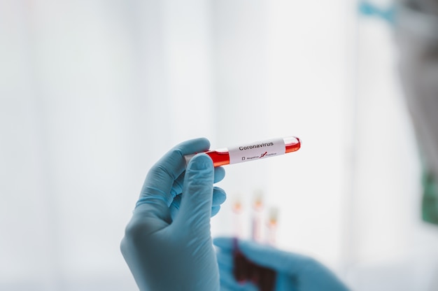 Foto vista posteriore della mano del medico che indossa il guanto che tiene il test in provetta di sangue con risultato positivo al coronavirus in laboratorio