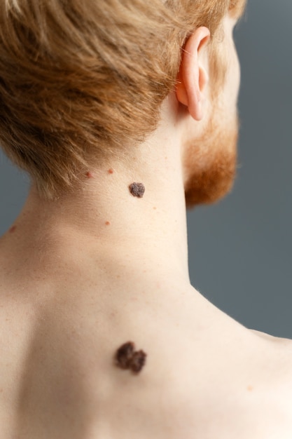 back view man with moles on back