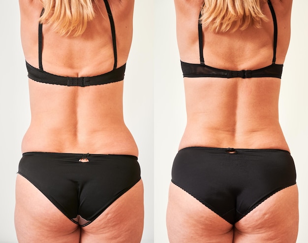 Back view of woman's body before and after weight loss plastic surgery concept