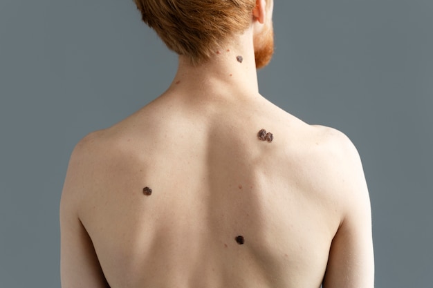 back view young man with moles on back