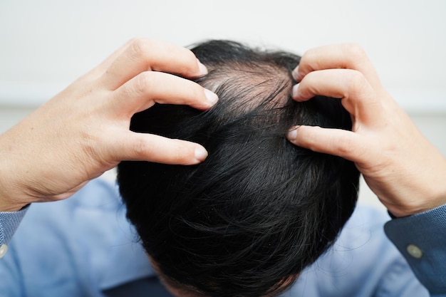 Photo bald head in man hair loss treatment health problem