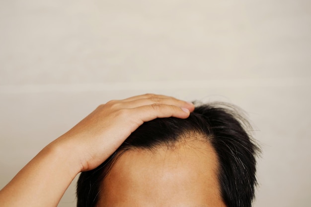 Bald men and gray hair are caused by stress