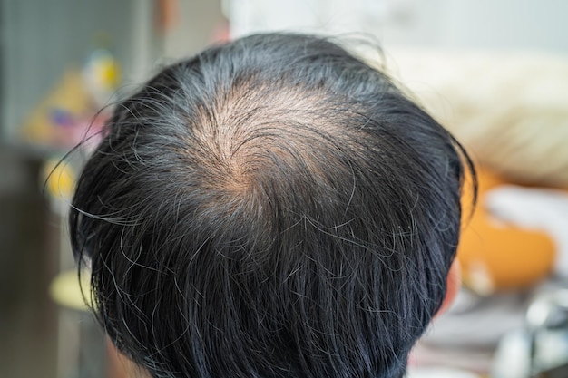 頭の中腹にハゲがあり、成熟したアジアのビジネススマートなアクティブなオフィスマンの無毛の脱毛が始まります。