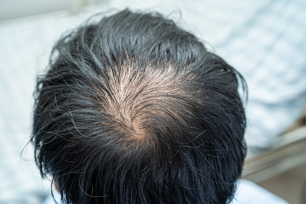 Premium Photo | Bald in the middle head and begin no loss hair glabrous of mature asian business smart active office man Premium Photo | Bald in the middle head and begin no loss hair glabrous of mature asian business smart active office man