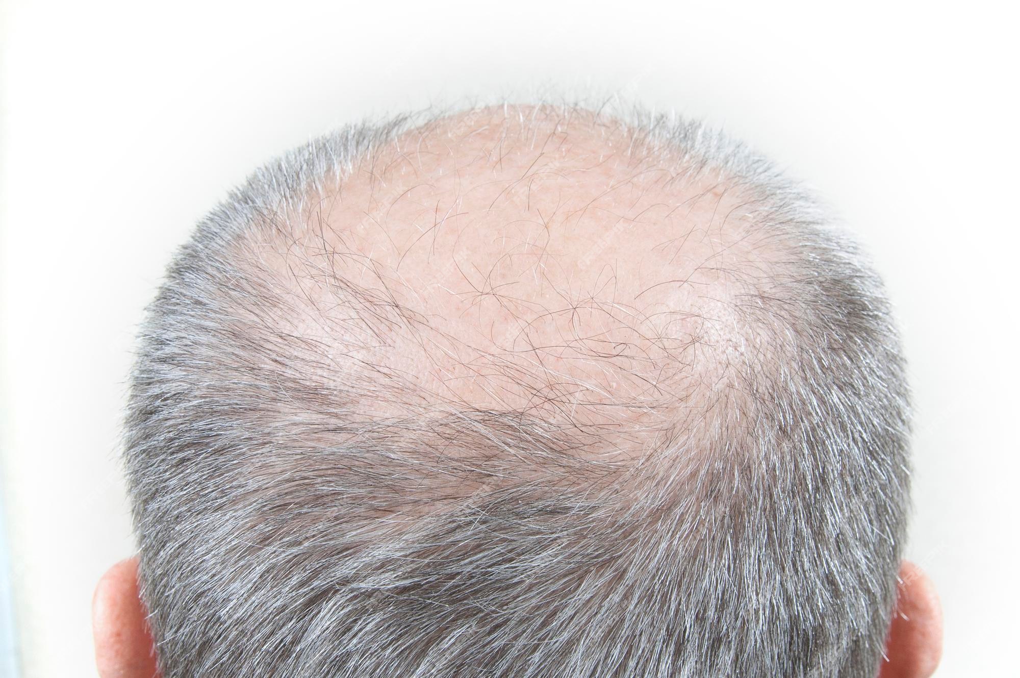Premium Photo | Bald spot on the head, gray hair, close-up view from  behind, the problem of hair loss.