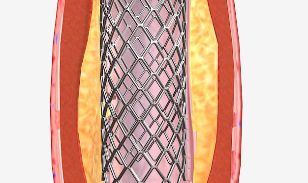 バルーンが消費されてワイヤーメッシュステントと動脈が拡張されます