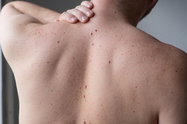 Bare skin on a man back with scattered moles and freckles