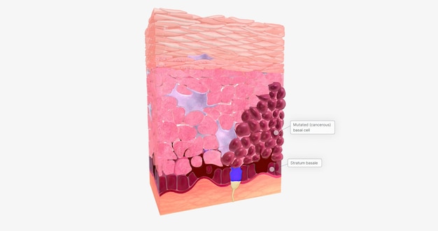 Basal Cell Carcinoma in Tissue Stage 0