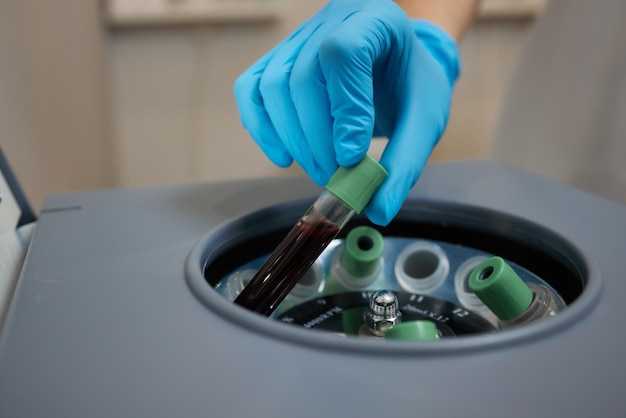 Beautician doctors hands put test tube with blood in centrifuge container rejuvenation plasmolifting