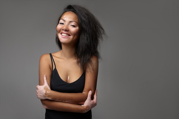 Photo beautiful african girl in studio with skin problems vitiligo