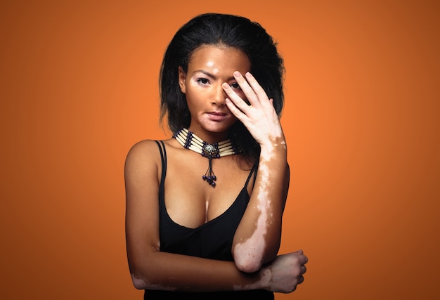 Photo beautiful african girl in studio with skin problems vitiligo.