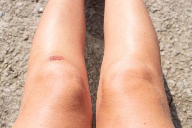 부러진 무릎을 가진 아름다운 여성의 다리. 추락, 부상에 대한 응급 처치.