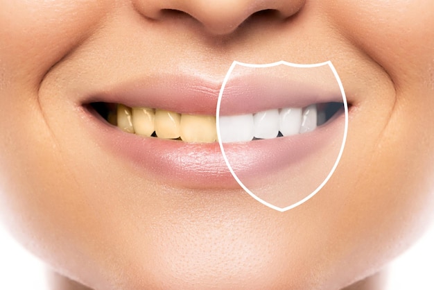 写真 美しい女性の笑顔。歯のホワイトニングと衛生。専門の歯科医院での治療後の結果。