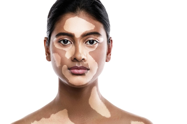 Beautiful South Asian woman with vitiligo skin disorder against white background