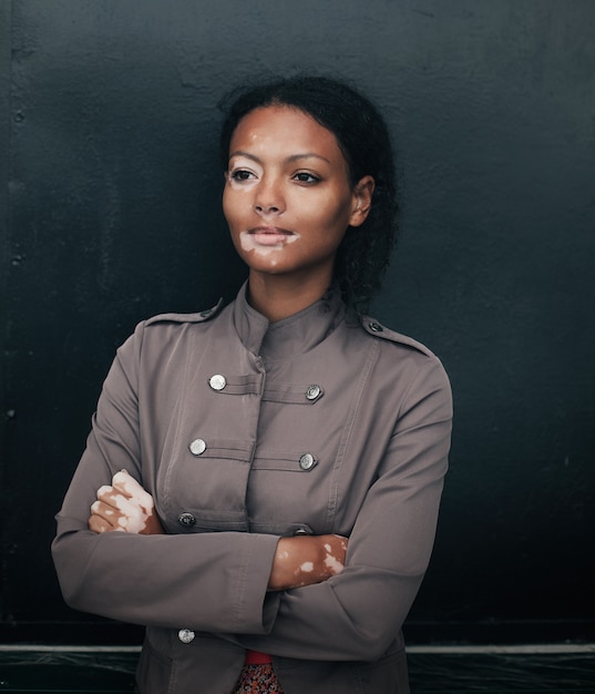 Beautiful young brunette woman with vitiligo disease