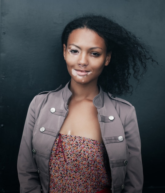 Beautiful young brunette woman with vitiligo disease