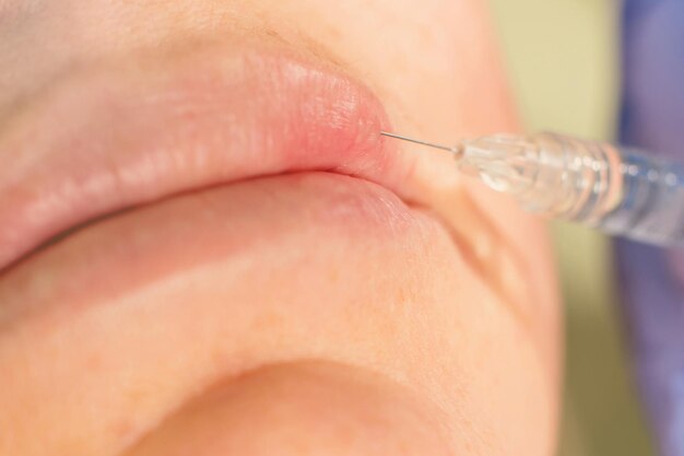 Beauty injections Close Up. Lip filler injection.