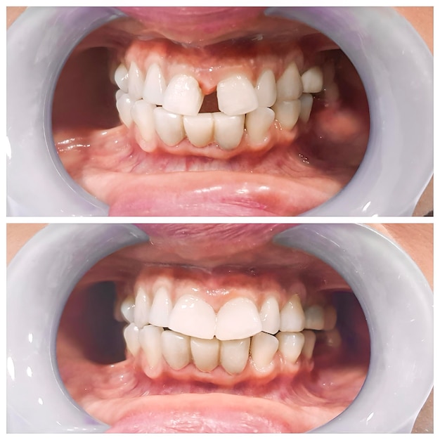 Before and after fixation for huge gap between front teeth or incisors diastema