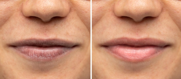 Before and after a treatment for aged lips