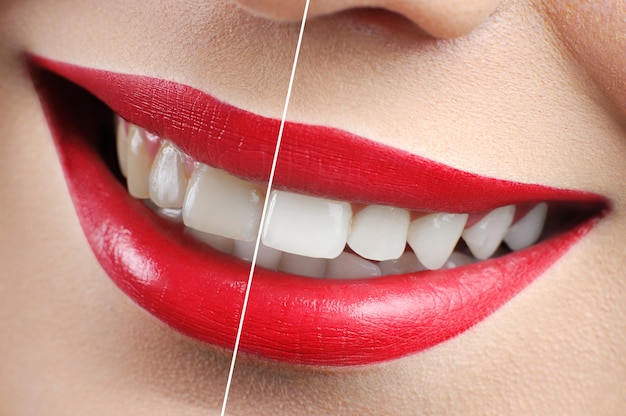 Фото До и после выстрела из красных губ женщины отбеливание зубов