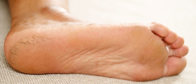 Behandeling van gebarsten hiel De voetcrème moet regelmatig worden aangebracht. Wrijf en masseer de hielen zodat de crème goed intrekt. Helpt vocht aan de huid van de voeten toe te voegen