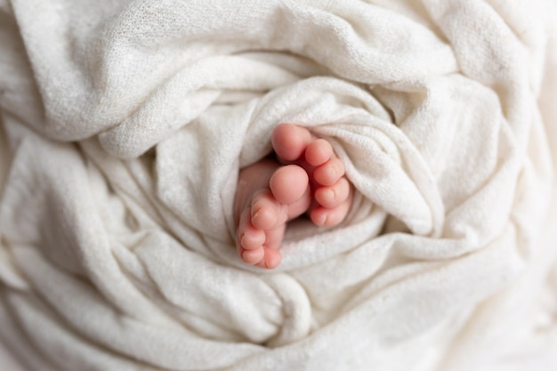 benen van een pasgeborene met korstjes op de huid. acne pasgeboren
