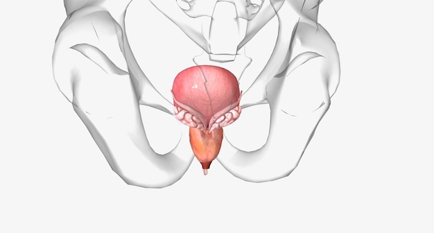 Photo benign prostatic hyperplasia bph is a noncancerous condition in which the prostate becomes enlarged with age