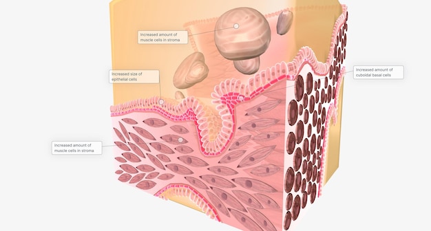 benign prostatic hyperplasia in prostatic tissue