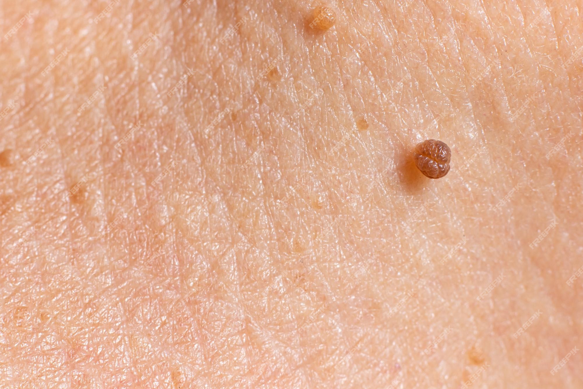 benign nevus