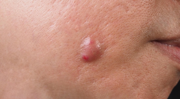 Big Acne Cyst Abscess or Ulcer Swollen area within face skin tissue