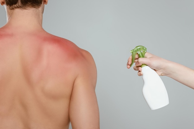 Bijgesneden beeld van vrouw die spray op mannelijke rug aanbrengt met roodheid geïsoleerd op grijs