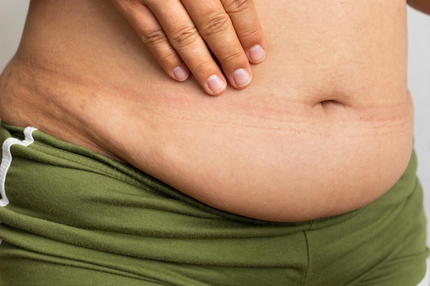 Bijgesneden overgewicht en dikke vrouwelijke buik aanraken van naakte overmatige slappe buik met navel in groene broek gewichtsverlies