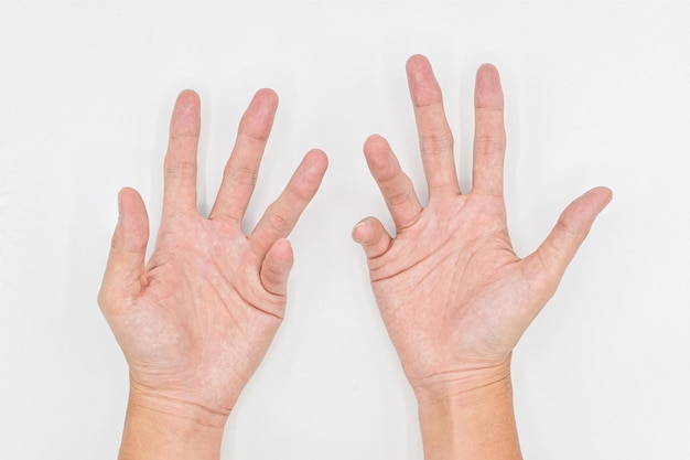 Bilateral Dupuytren's contracture in Asian young man Bilateral hand abnormality