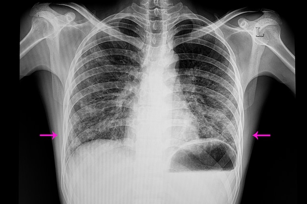 Bilateral lower lungs pneumonia