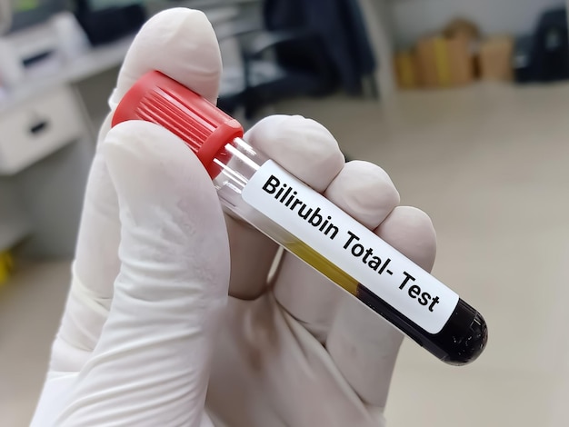 Biochemicus of arts heeft bloedmonster voor Bilirubin Total Test