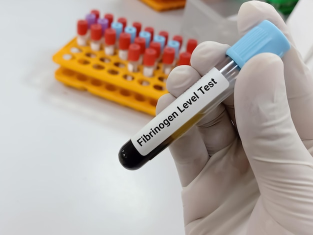 Biochemicus of laboratoriumtechnoloog houdt bloedmonster voor fibrinogeenniveau (factor 1) test,