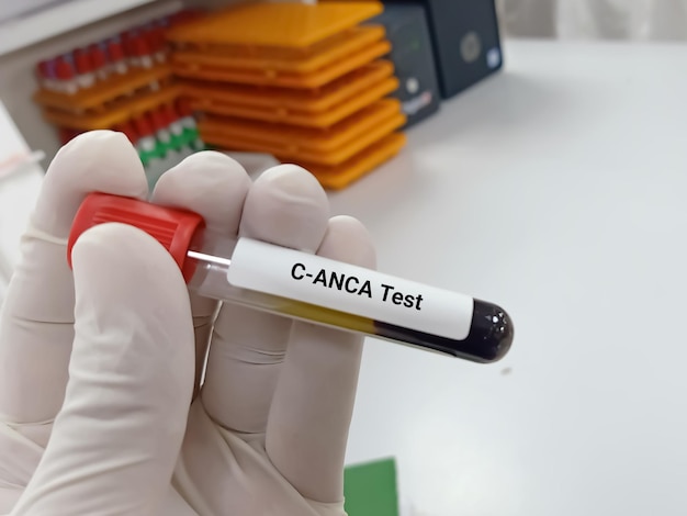 Biochemicus of laboratoriumtechnoloog houdt bloedmonsters voor cANCA (Anti-neutrofiel cytoplasmatisch antilichaam),