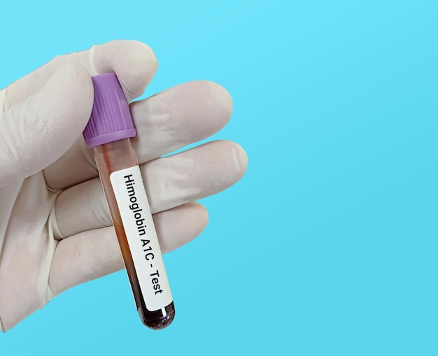 생화학자 또는 실험실 기술자는 HbA1c 헤모글로빈 A1c에 대한 혈액 샘플을 보유하고 있습니다.