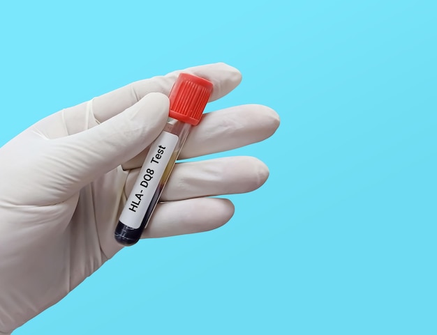 Biochemist or Lab Technologist holds Blood sample for HLADQ8 test