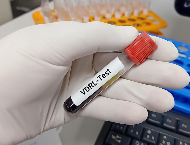 생화학자 또는 실험실 기술자는 VDRL 성병 연구 실험실을 위한 혈액 샘플을 보유하고 있습니다.