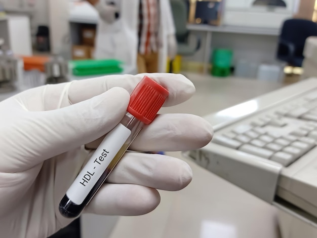 写真 生化学者または検査技師は、hdl（高密度リポタンパク質）検査用の血液サンプルを保持しています。