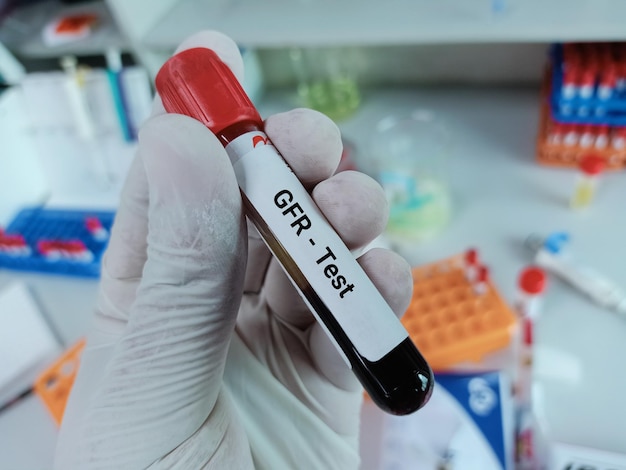 Photo biochemist of scientist holds blood sample for glomerular filtration rate (gfr) test.