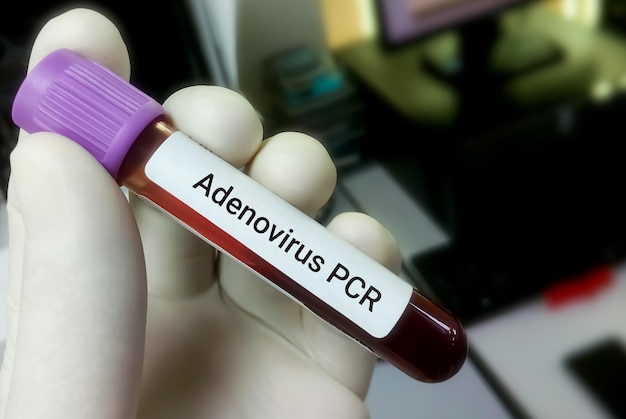 Биолог держит образец крови с размытым фоном для теста ПЦР на аденовирус