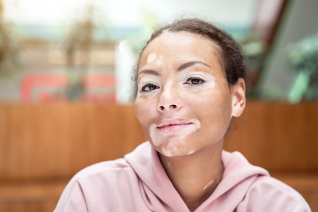 Black african american woman with vitiligo pigmentation skin problem indoor dressed pink hoodie close up portrait pensive black female thinking about