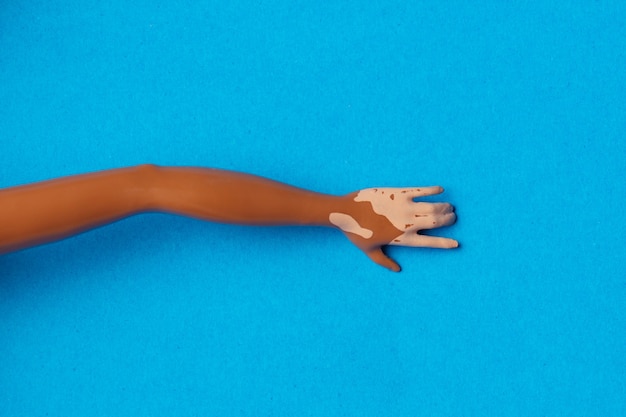 Photo black girl doll hold hand with viteligo on blue background